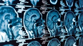 Alimlər beyin xərçənginin müalicəsində əsas problemlərdən birini aradan qaldırdı