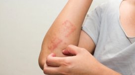 Qida allergiyası nədir?