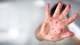 Meymunçiçəyi virusu qapıdadır?