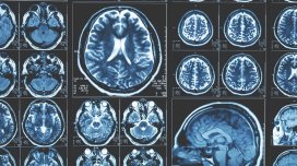 Karbon dioksid Alzheimer xəstəliyinə qarşı təsir göstərə bilər