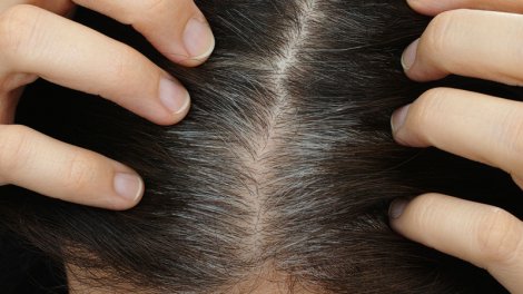 Alimlər saçların ağarması ilə dəri xərçəngi riski arasında əlaqə tapdı