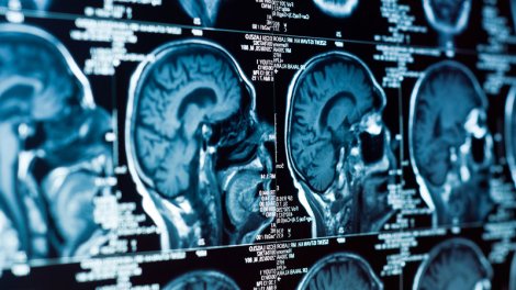 Alimlər müəyyən etdi: Niyə beyin yuxusuz gecədən sonra "yavaşlayır"?