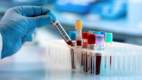 Qan xərçənginin müalicəsində yeni və təhlükəsiz üsul tapıldı