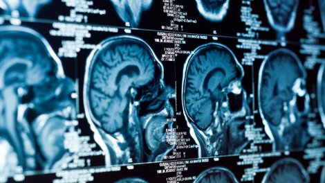 Alimlər: Stress beyin qan dövranını poza bilər