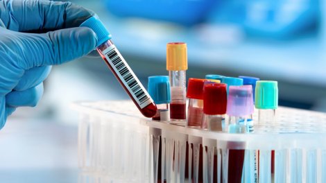 Ağ ciyər xərçəngini tək bir hüceyrə ilə aşkar etmək mümkün oldu