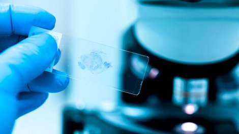 Qastroenteroloq: Üç pəhriz nümunəsi xərçəng riskini azaldır