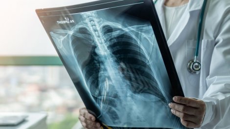 Açıq görünməyən ağciyər xərçəngi əlaməti müəyyən edildi