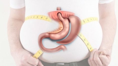 Kimlər mədə kiçiltmə əməliyyatını etdirə bilər?