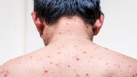 İsti havaların problemi: Suçiçəyi təhlükəsi
