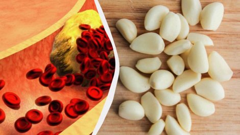 Daha çox sarımsaq yesəniz, xolesterinlə nə baş verə bilər?