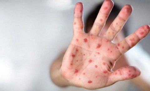 Hansı allergik reaksiyalar zamanı antibiotik təyin edilməlidir? - AÇIQLAMA