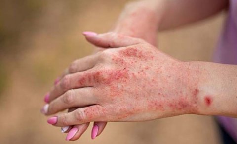 Dünyada təşviş yaradan xəstəlik: Azərbaycanda vəziyyət necədir?