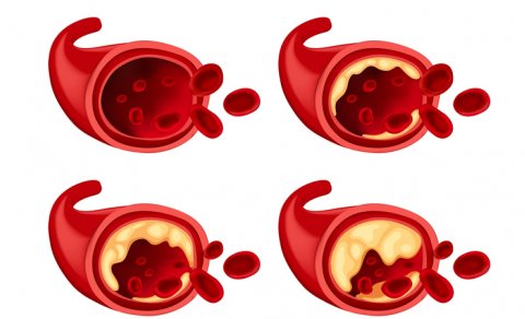 Həkimlər aterosklerozla mübarizə üçün yeni üsul tapdı