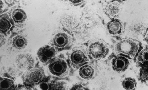 Alimlər herpes virusu ilə dəri xərçənginə qalib gəldi