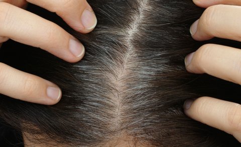 Alimlər saçların ağarması ilə dəri xərçəngi riski arasında əlaqə tapdı