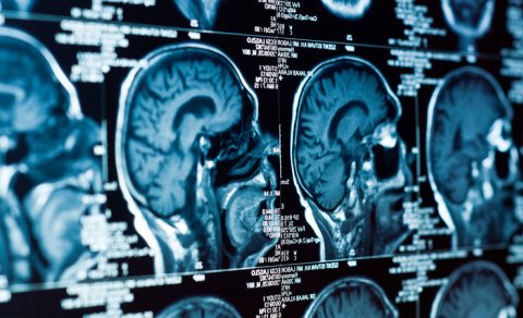 Alimlər müəyyən etdi: Niyə beyin yuxusuz gecədən sonra "yavaşlayır"?