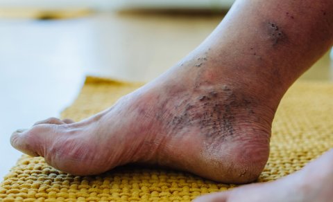 Diabet xəstələrində yaraların sağalmasını sürətləndirən dərman yaradıldı