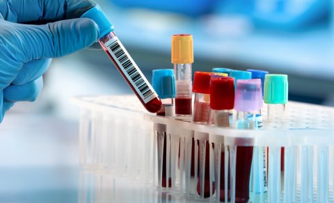 COVID-19 sağ qalanların qanında qeyri-adi dəyişikliklər aşkar edildi