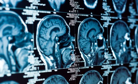 Alimlər beyin xərçənginin müalicəsində əsas problemlərdən birini aradan qaldırdı