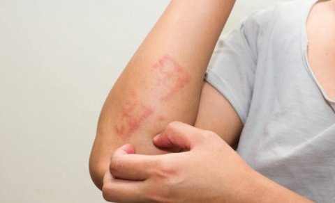 Qida allergiyası nədir?