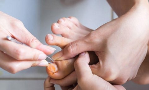 Dırnaq batması problemi nədir?