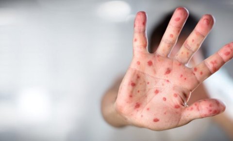 Meymunçiçəyi virusu qapıdadır?