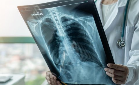 Açıq görünməyən ağciyər xərçəngi əlaməti müəyyən edildi