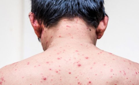 İsti havaların problemi: Suçiçəyi təhlükəsi