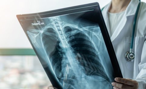 Yaşlılar üçün ağciyər xərçənginin effektiv müalicə metodu açıqlandı