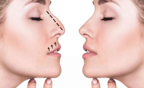 Burun əməliyyatı həvəsi: Ehtiyac, yoxsa təhlükə?