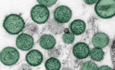 Hantavirus xəstəliyi yayılıb?