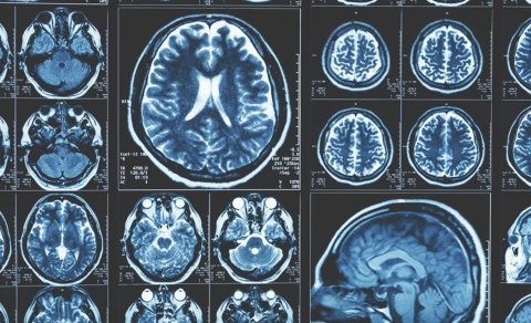 Karbon dioksid Alzheimer xəstəliyinə qarşı təsir göstərə bilər