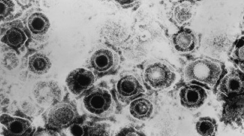 Alimlər herpes virusu ilə dəri xərçənginə qalib gəldi