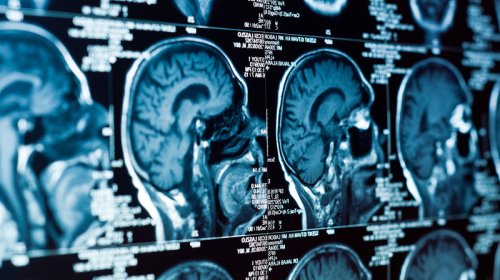 Alimlər müəyyən etdi: Niyə beyin yuxusuz gecədən sonra "yavaşlayır"?