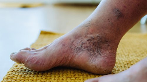 Diabet xəstələrində yaraların sağalmasını sürətləndirən dərman yaradıldı