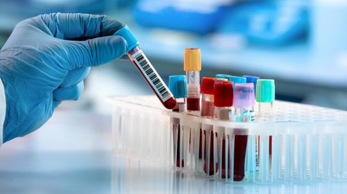 Qan xərçənginin müalicəsində yeni və təhlükəsiz üsul tapıldı