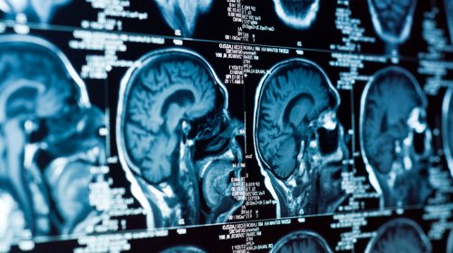 Alimlər: Stress beyin qan dövranını poza bilər