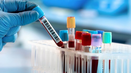 Ağ ciyər xərçəngini tək bir hüceyrə ilə aşkar etmək mümkün oldu