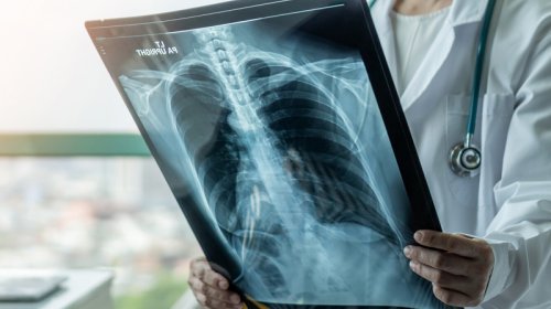 Açıq görünməyən ağciyər xərçəngi əlaməti müəyyən edildi