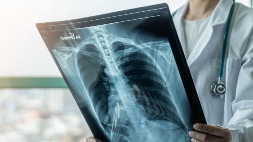 Yaşlılar üçün ağciyər xərçənginin effektiv müalicə metodu açıqlandı