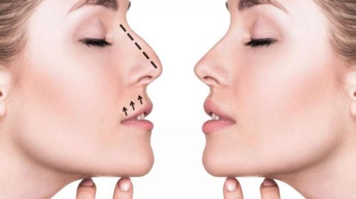 Burun əməliyyatı həvəsi: Ehtiyac, yoxsa təhlükə?