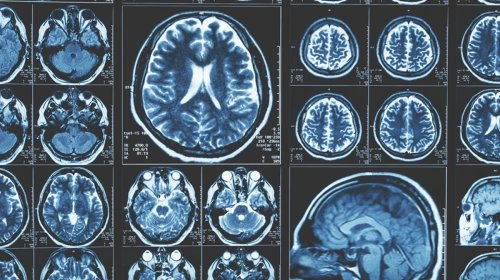 Karbon dioksid Alzheimer xəstəliyinə qarşı təsir göstərə bilər