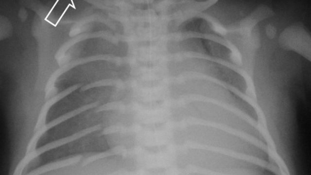 Məşhur müğənni yıxılıb qabırğasını çatlatdı (FOTO)