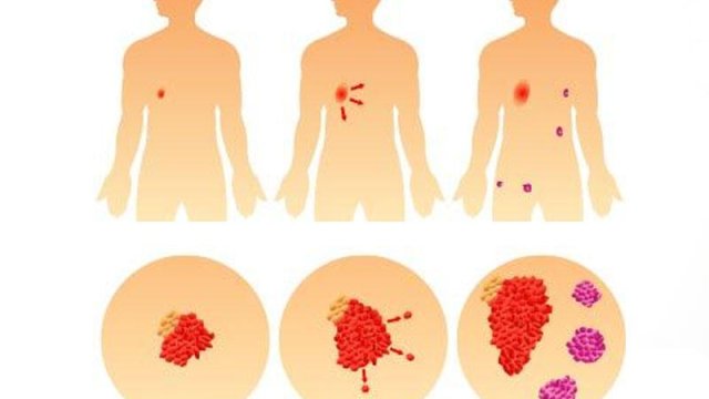 Bəzi xərçəng şişlərini əməliyyat və müalicə etmək əslində lazım deyil - ALİMLƏRDƏN ŞOK