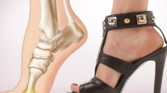 Dar və hündürdaban ayaqqabılar yastıpəncəliliyə səbəb ola bilər