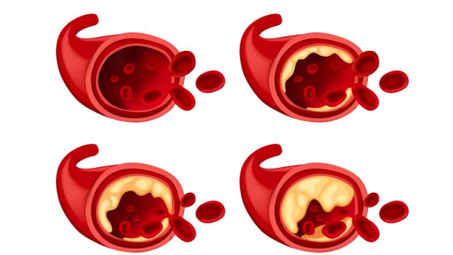 Həkimlər aterosklerozla mübarizə üçün yeni üsul tapdı