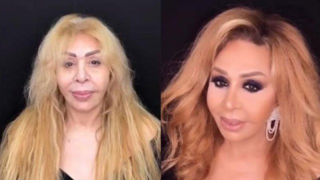 Əməkdar artist estetik əməliyyatın qurbanı oldu: \