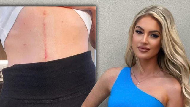 27 yaşlı model xərçəngə tutuldu, 7 saat əməliyyat olundu, sevgilisindən ayrıldı - FOTO