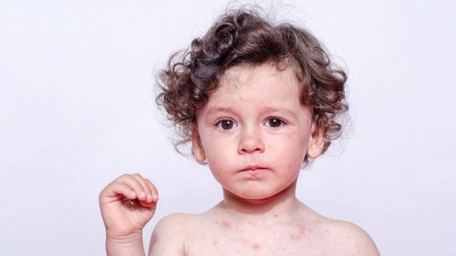 Məktəblərdə qızılcaya qarşı hansı tədbirlər görülür? - Nazirlikdən açıqlama