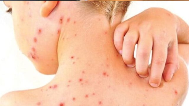 Qızılca Azərbaycanda epidemiyaya səbəb ola bilər? - İnfeksionistdən AÇIQLAMA